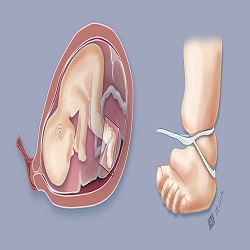 Amniotic band syndrome