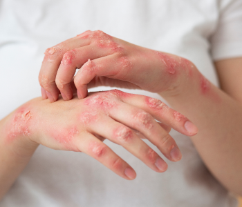 ECZEMA