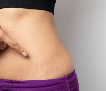 STRETCH MARKS
