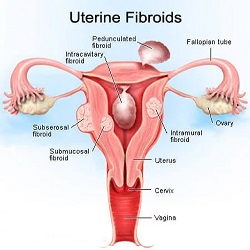 Uterine Fibroids External