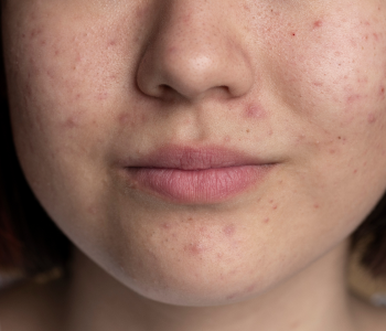 ACNE AND ACNE SCARS
